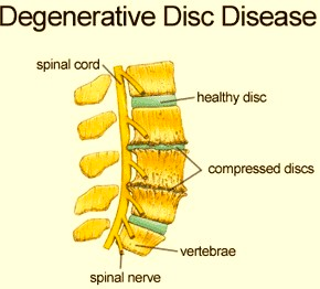 Degenerative Disc Disease DDD awareness products Degenerative Disc Disease  DDD Awareness Butterfly Support Throw Pillow, 18x18, Multicolor